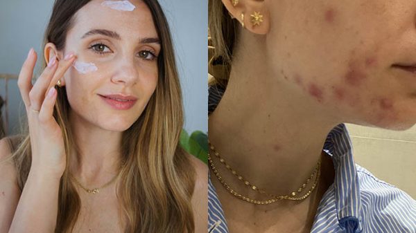 sonia grispo skincare brufoli