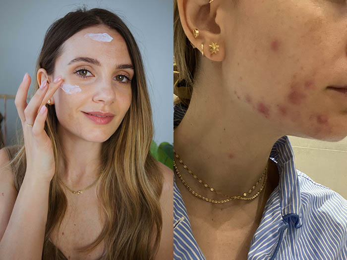 sonia grispo skincare brufoli